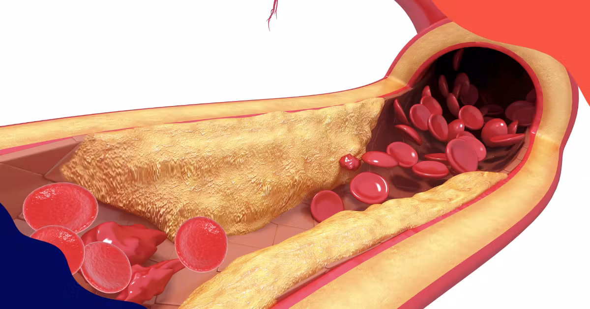 MHC Blog HowAtherosclerosisLeadstoErectileDysfunction July2024 KT V1 1 1 2