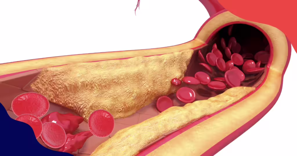 MHC Blog HowAtherosclerosisLeadstoErectileDysfunction July2024 KT V1 1 1 2